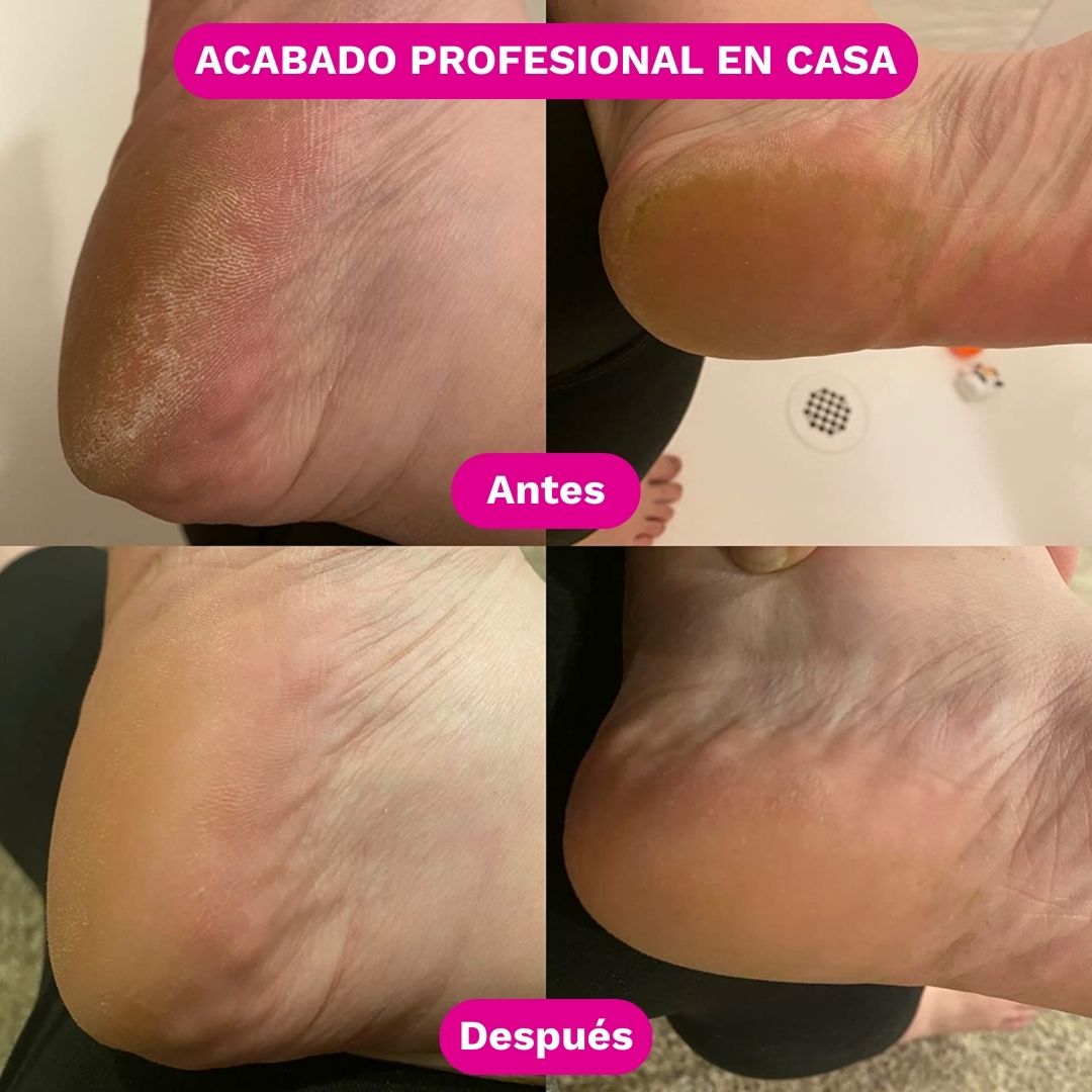 SilkRose™ Removedor de Callos Profesional en Casa