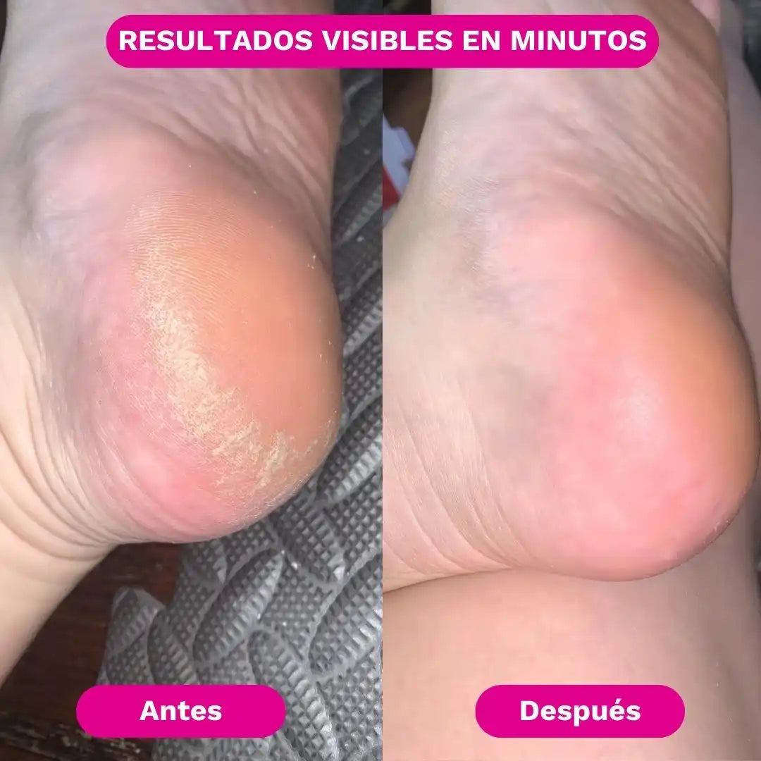 SilkRose™ Removedor de Callos Profesional en Casa
