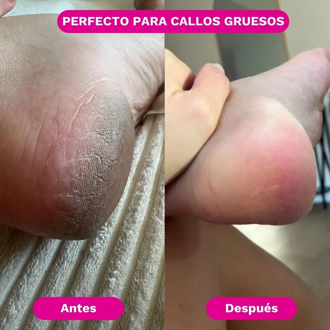 SilkRose™ Removedor de Callos Profesional en Casa