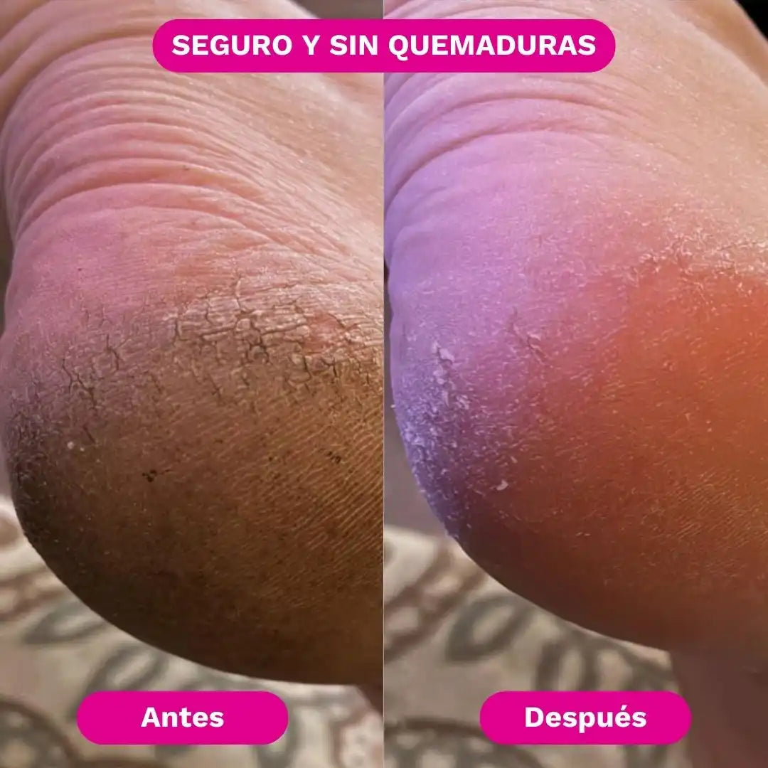SilkRose™ Removedor de Callos Profesional en Casa