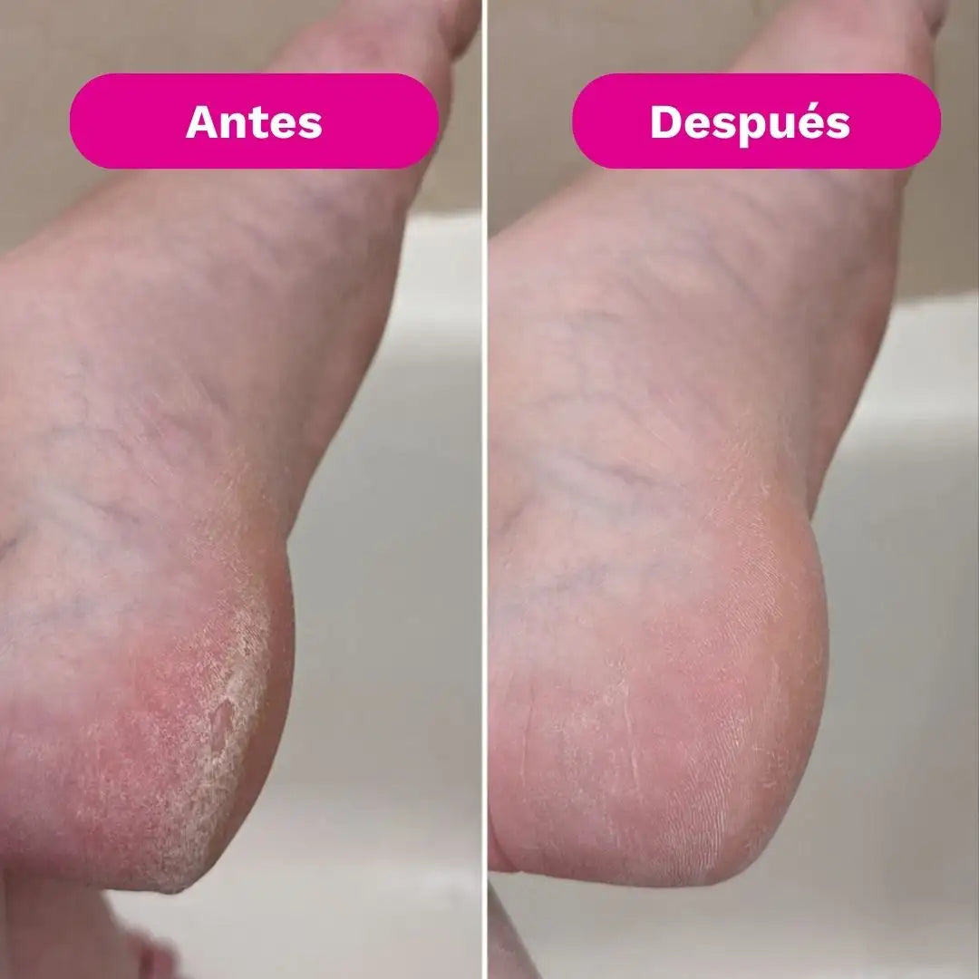 SilkRose™ Removedor de Callos Profesional en Casa