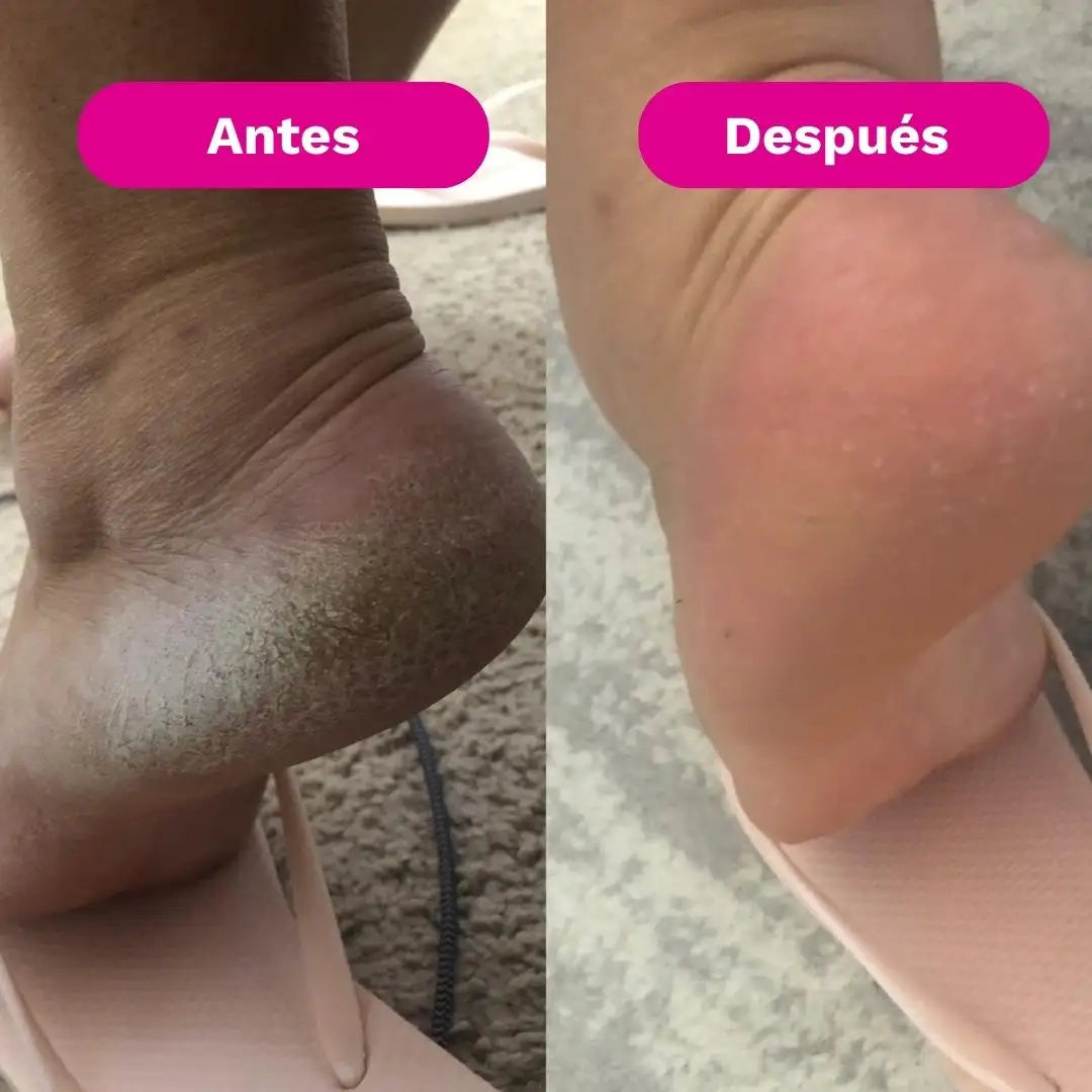 SilkRose™ Removedor de Callos Profesional en Casa