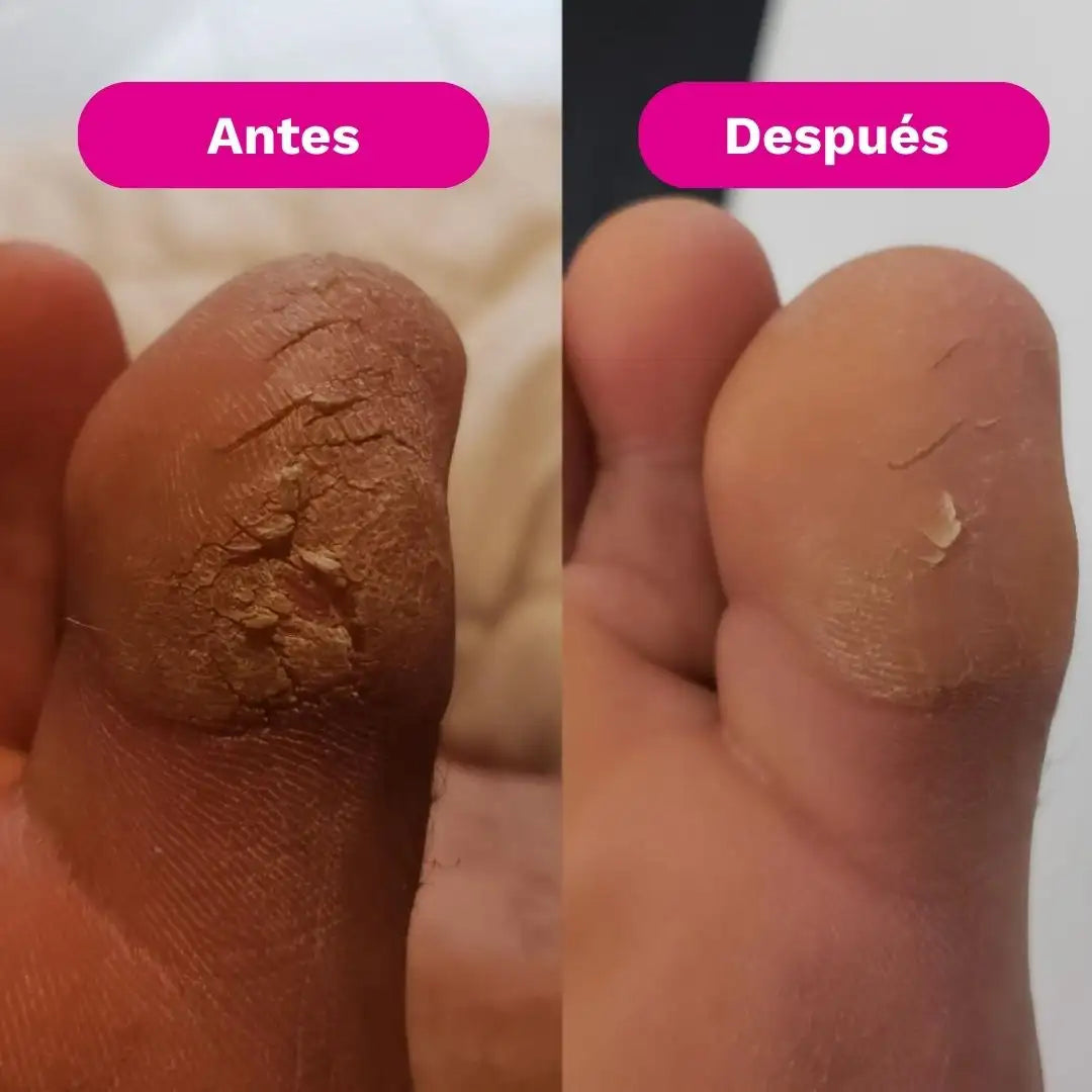 SilkRose™ Pro Removedor de Callos Profesional en Casa