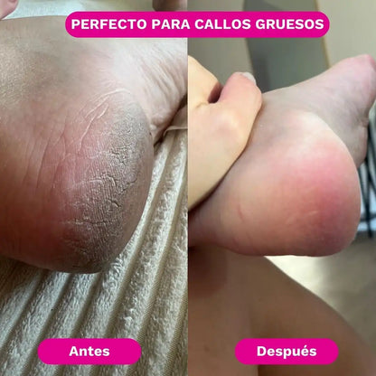 SilkRose™ Removedor de Callos Profesional en Casa